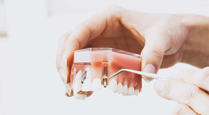 Dental Implants Vancouver